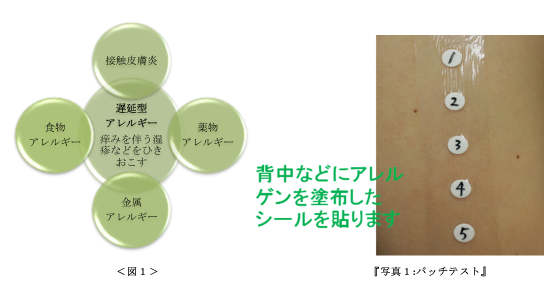 遅延型アレルギー<図1>