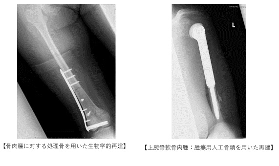 骨肉腫再建