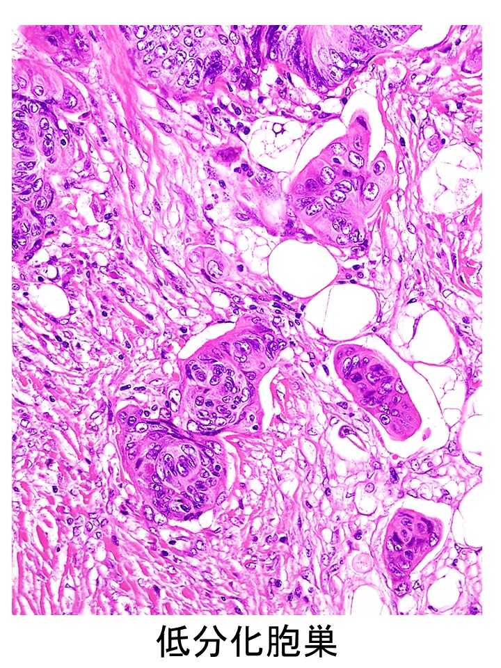 低分化胞巣