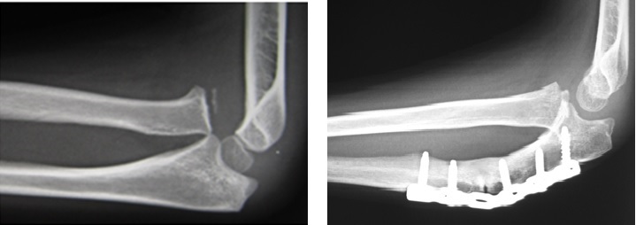 陳旧性Monteggia脱臼骨折に対する矯正骨切り術