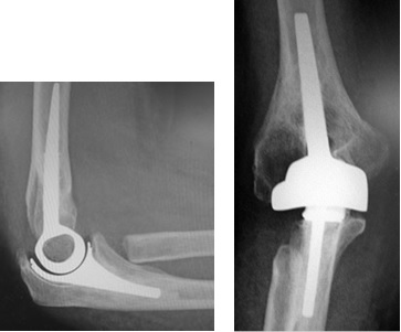 RA肘に対する人工肘関節置換術
