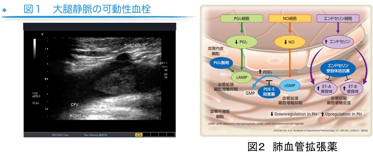 図1 大腿静脈の可能性血栓 図2 肺血管拡張薬