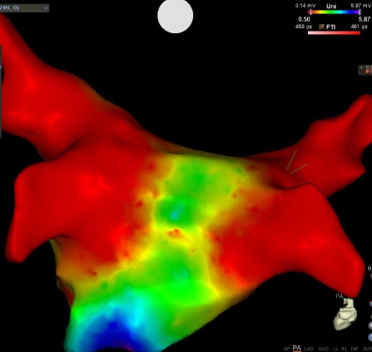 心房細動に対する肺静脈隔離術後：左房Voltage map