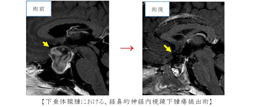 下垂体腺腫における経鼻的神経内視鏡下腫瘍摘出術