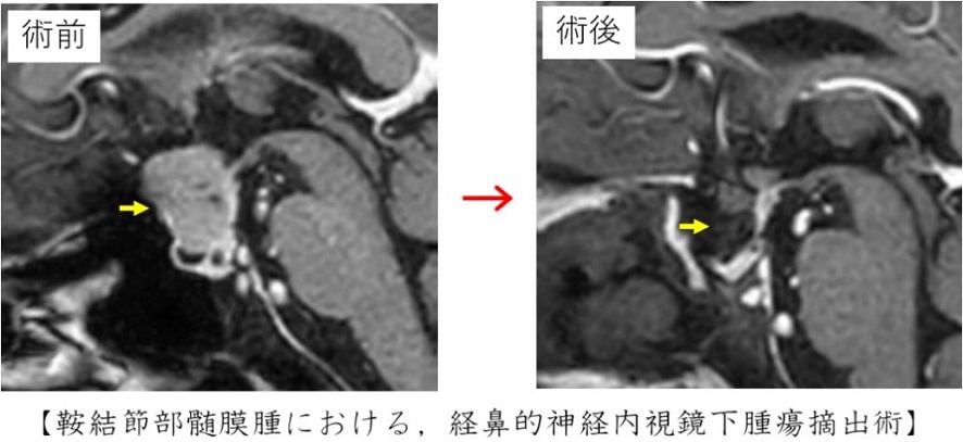 鞍結節部髄膜腫における経鼻的神経内視鏡下腫瘍摘出術