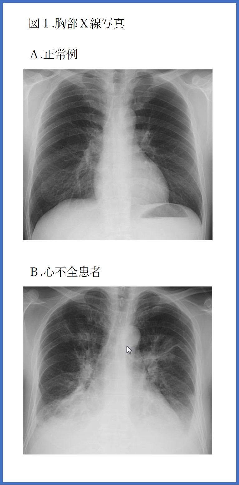 図1胸部X線写真