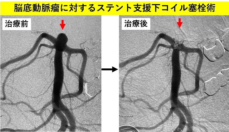 脳底動脈瘤に対するステント支援課コイル塞栓術