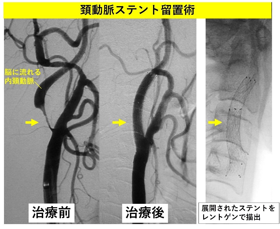 頸動脈ステント留置術