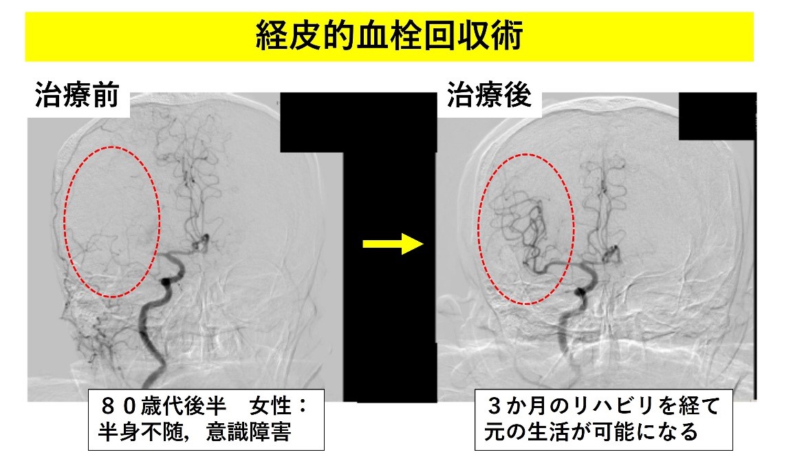 経皮的血栓回収術